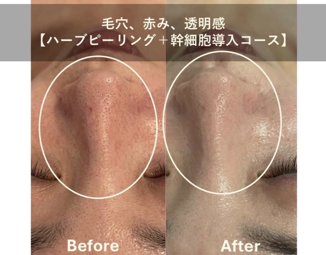 Luxury 70-Min Facial & Head Massage Plan: Pore Cleansing & Slimming Care