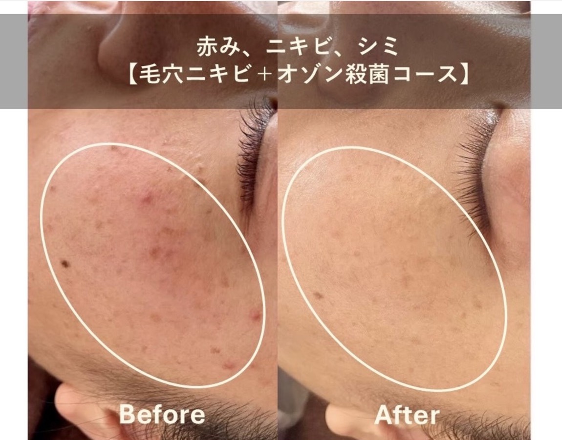 Luxury 70-Min Facial & Head Massage Plan: Pore Cleansing & Slimming Care